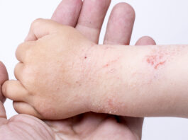 Allergie ed eczema allergico