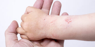 Allergie ed eczema allergico