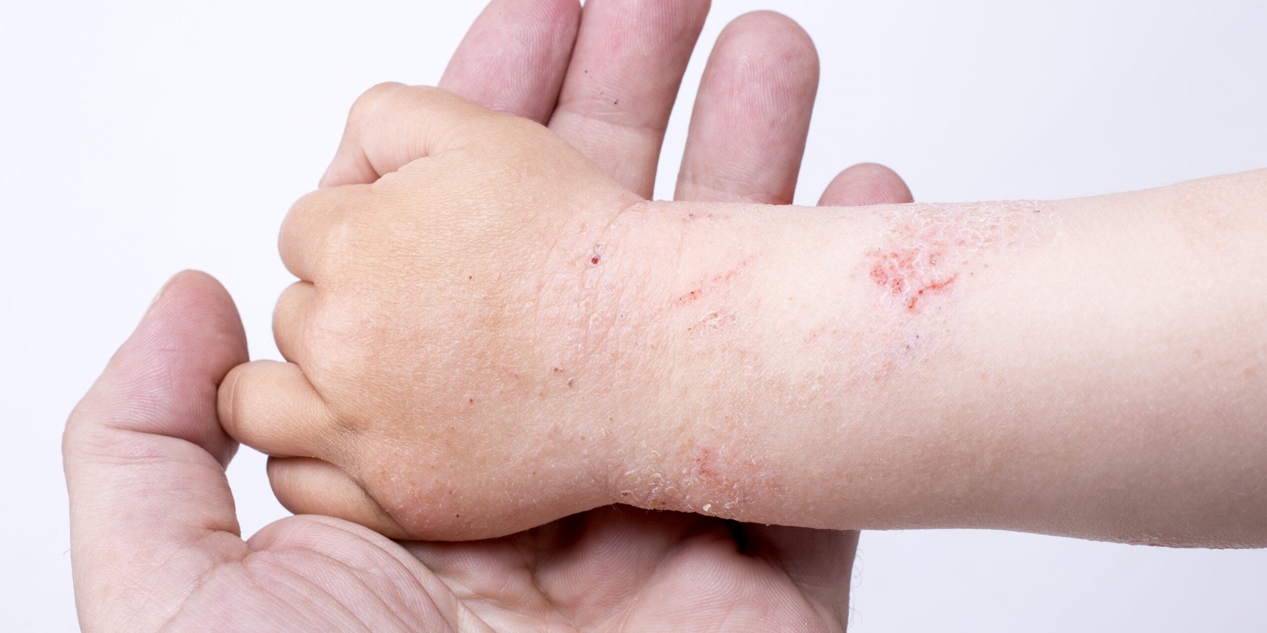 Allergie ed eczema allergico