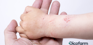 Allergie ed eczema allergico