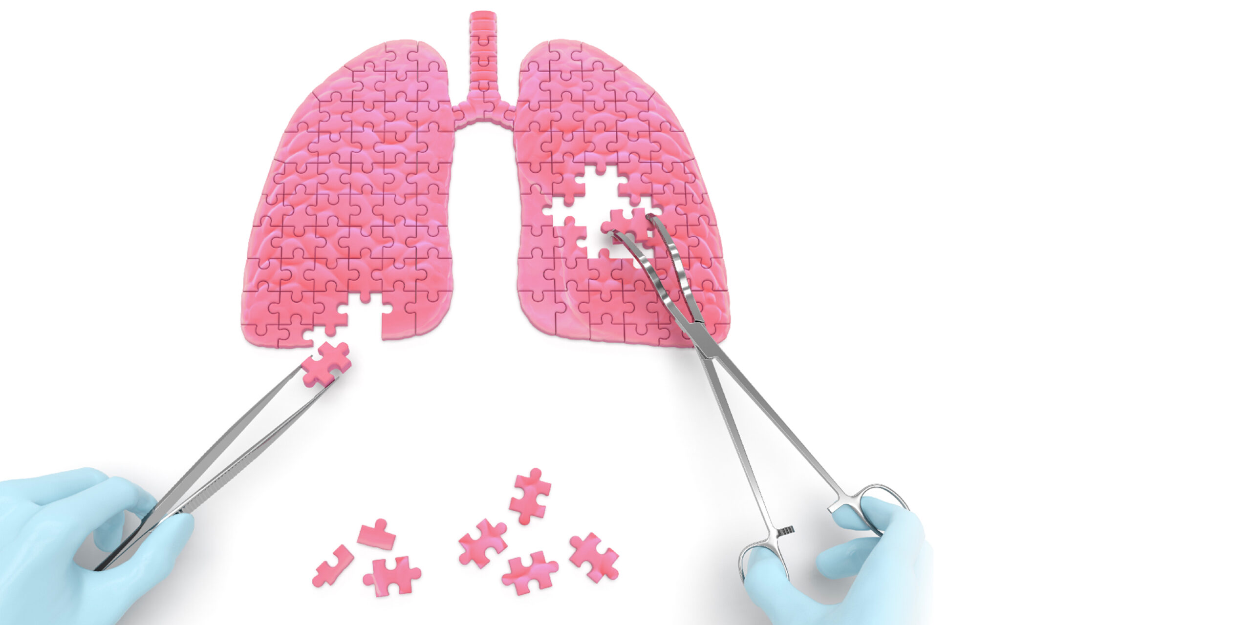 fibrosi polmonare vitamina D